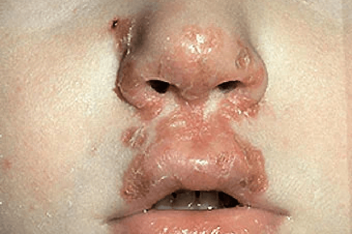 Diffuse Impetigo Rash Is it Eczema or Just a Common Rash? | Here’s How to Tell the Difference