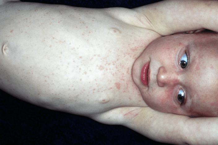 Roseola Rash Vs Chickenpox Rash Is it Eczema or Just a Common Rash? | Here’s How to Tell the Difference